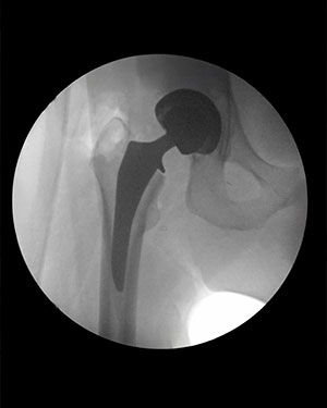 Icona Femoral Stem